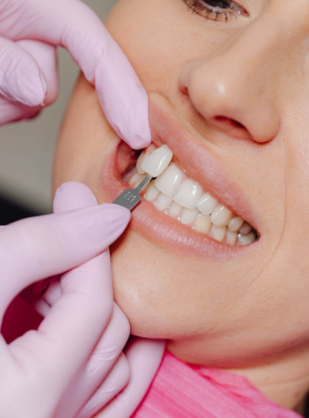 faccette dentali